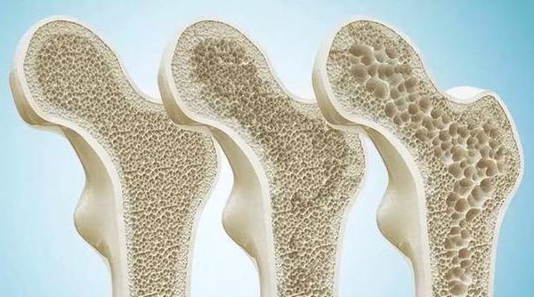 Osteoporosis prevention: Calcium supplementation, vitamin D, and exercise are all essential! Osteoporosis prevention: Calcium supplementation, vitamin D, and exercise are all essential!